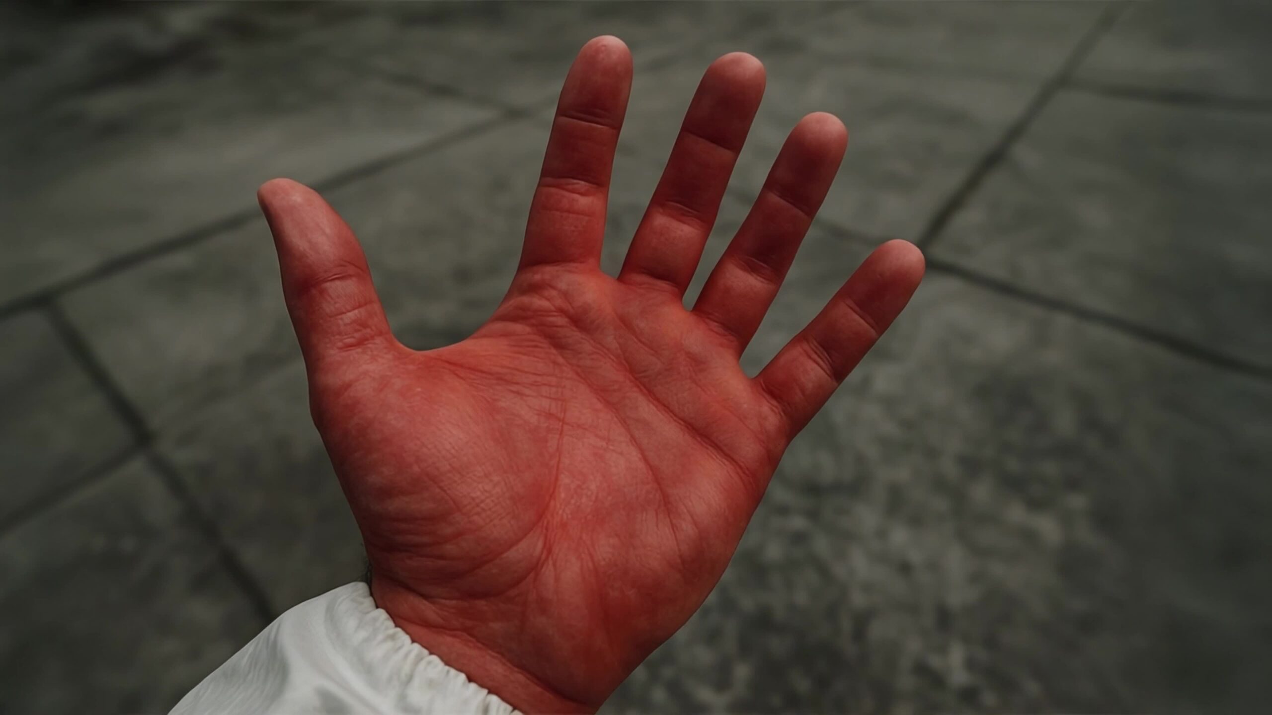Chernobyl’s Radiation Burns